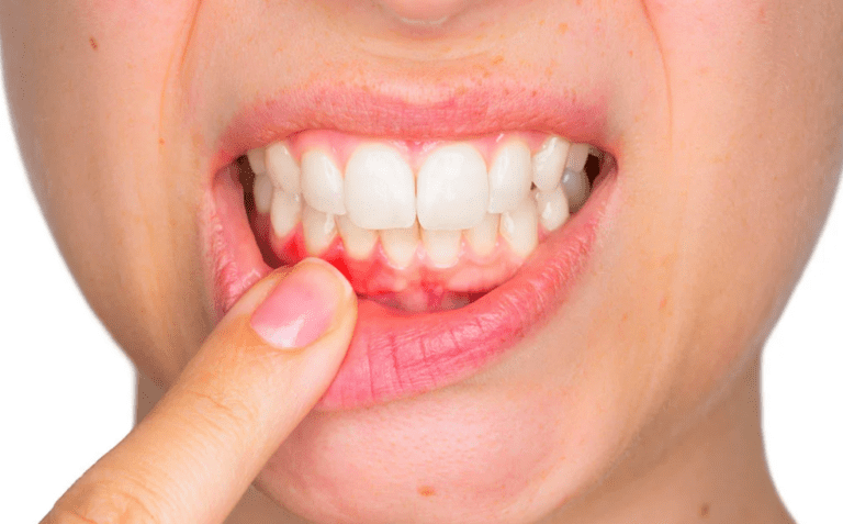 gencive gonflee dentiste